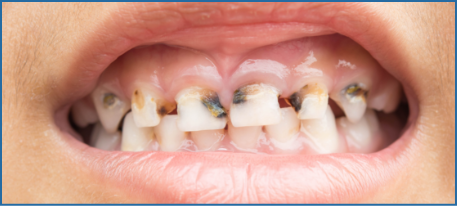 image of severe decay in child's teeth.