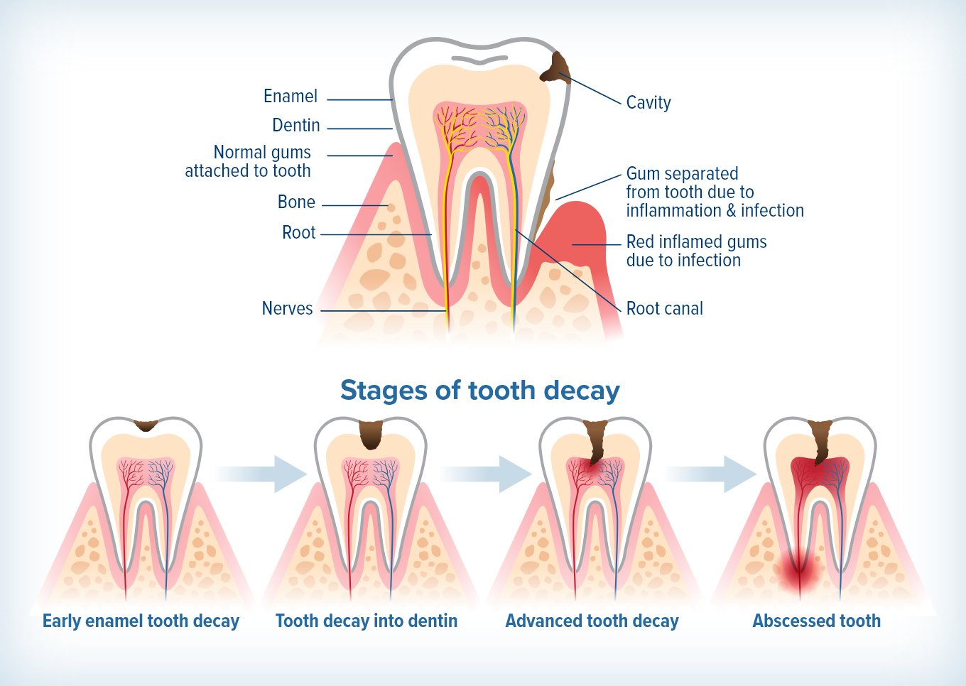 infographic showing the progression of tooth decay form early enamel tooth decay to abscessed tooth.